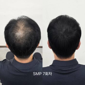 두피 smp